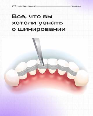 Шинирование зубов: профессиональные секреты долговечной улыбки.